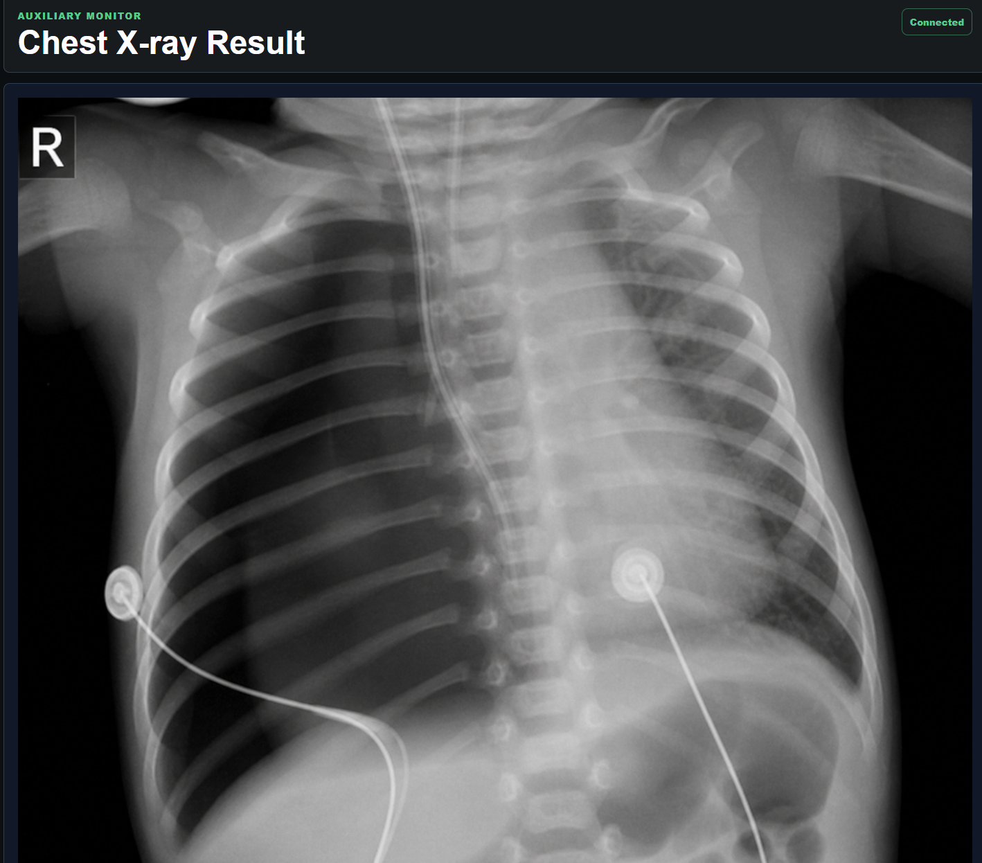 Steps InSitu auxiliary monitor displaying a chest X-ray result